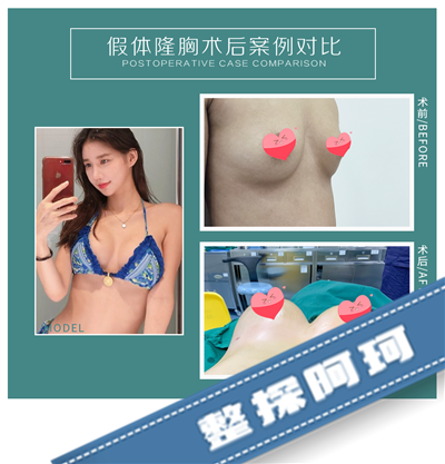 北京东方和谐医院孙泽芳院长复合隆胸术后两个月真实案例分享