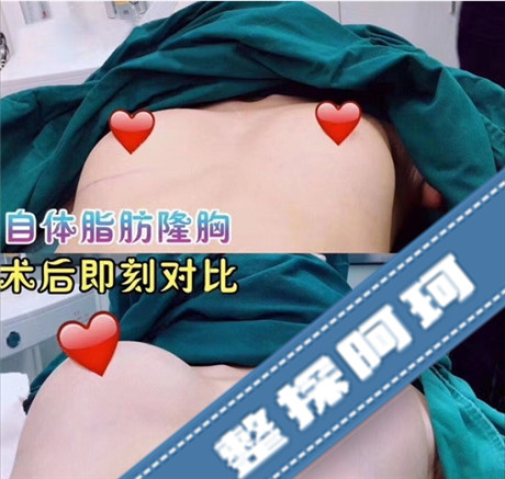 北京脂肪丰胸最好的医院有哪些